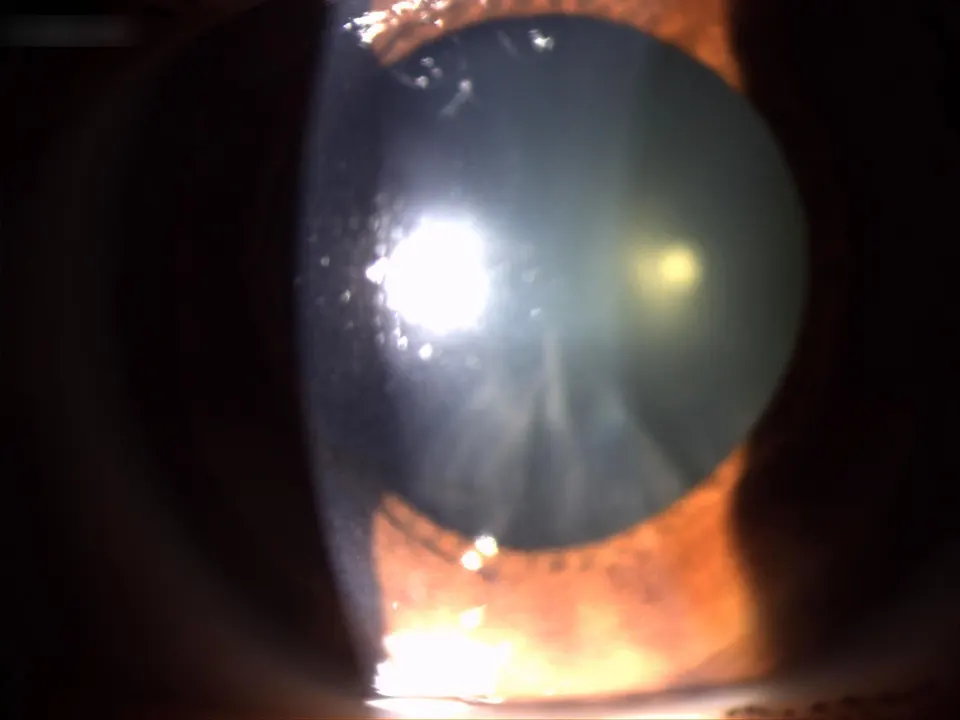 Slit-lamp photo of an eye with a cortical cataract