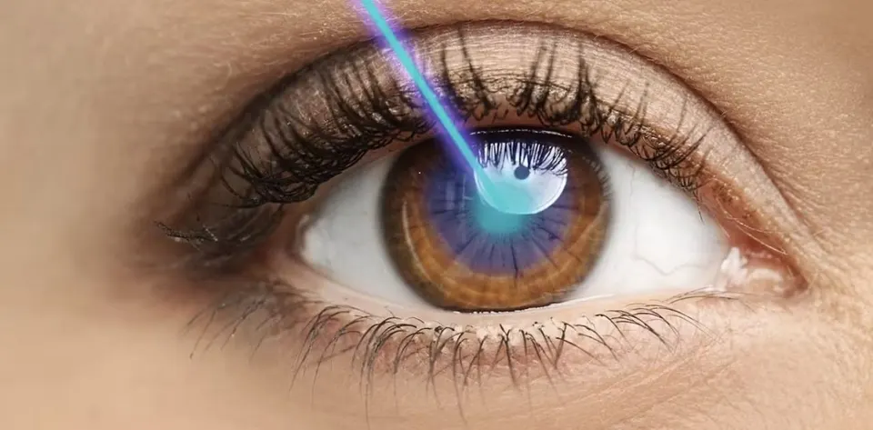Illustration of a brown eye with a light beam, representing vision correction